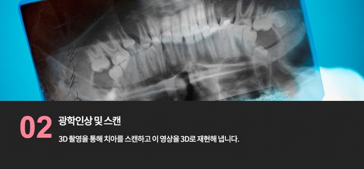 -광학인상 및 스캔
3D 촬영을 통해 치아를 스캔하고 이 영상을 3D로 재현해 냅니다.
