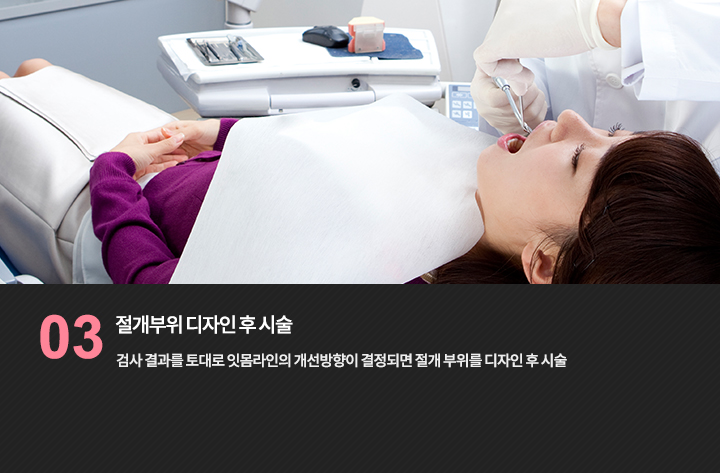 -절개부위 디자인 후 시술
검사 결과를 토대로 잇몸라인의 개선방향이 결정되면 절개 부위를 디자인 후 시술