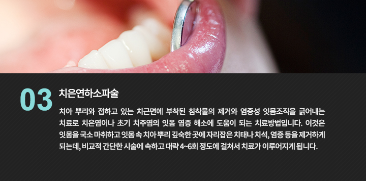 -치은연하소파술
치아 뿌리와 접하고 있는 치근면에 부착된 침착물의 제거와 염증성 잇몸조직을 긁어내는 치료로 치은염이나 초기 치주염의 잇몸 염증 해소에 도움이 되는 치료방법입니다. 이것은 잇몸을 국소 마취하고 잇몸 속 치아 뿌리 깊숙한 곳에 자리잡은 치태나 치석, 염증 등을 제거하게 되는데, 비교적 간단한 시술에 속하고 대략 4~6회 정도에 걸쳐서 치료가 이루어지게 됩니다.

